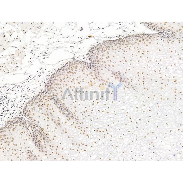 SMARCA1 Antibody - DF13543 at 1/100 staining Human esophageal cancer and adjacent normal tissues by IHC-P.