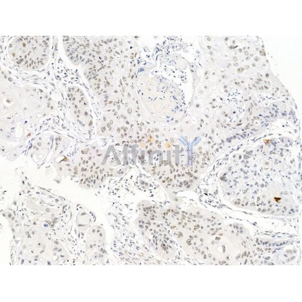 SMARCA1 Antibody - DF13543 at 1/100 staining Human esophageal cancer by IHC-P.