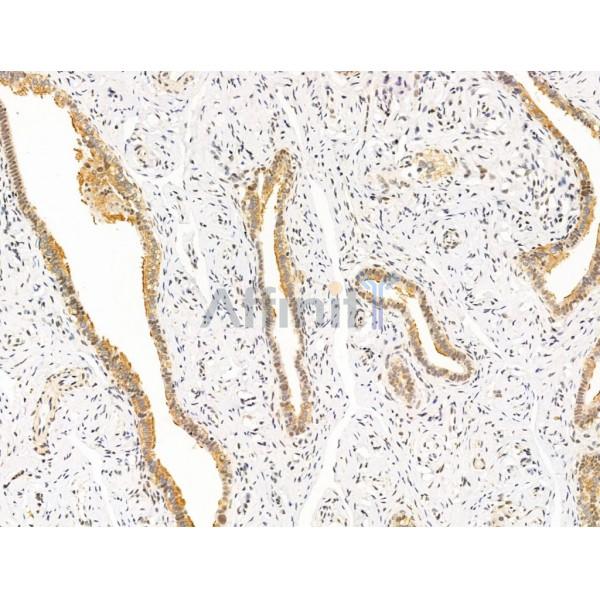 SMARCA1 Antibody - DF13543 at 1/100 staining Human ovarian cancer and adjacent normal tissues by IHC-P.