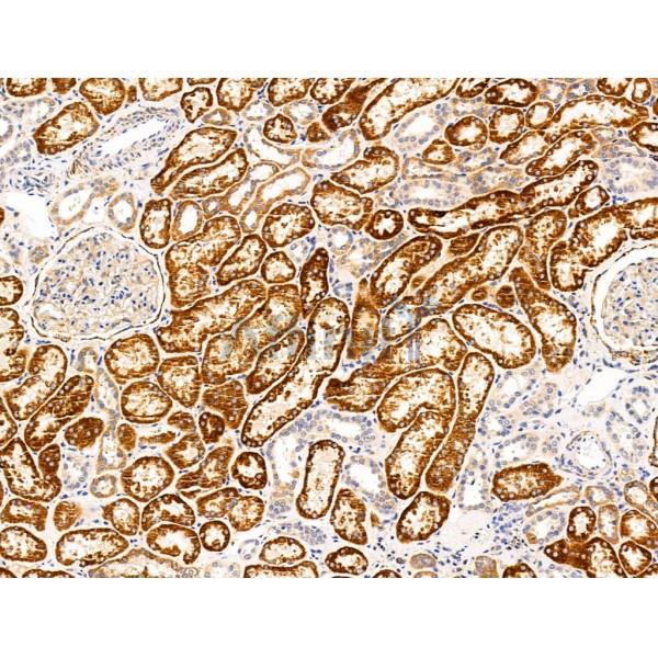 DPP6 - Catalytic domain Antibody - DF13546 at 1/100 staining Human kidney cancer and adjacent normal tissues by IHC-P.