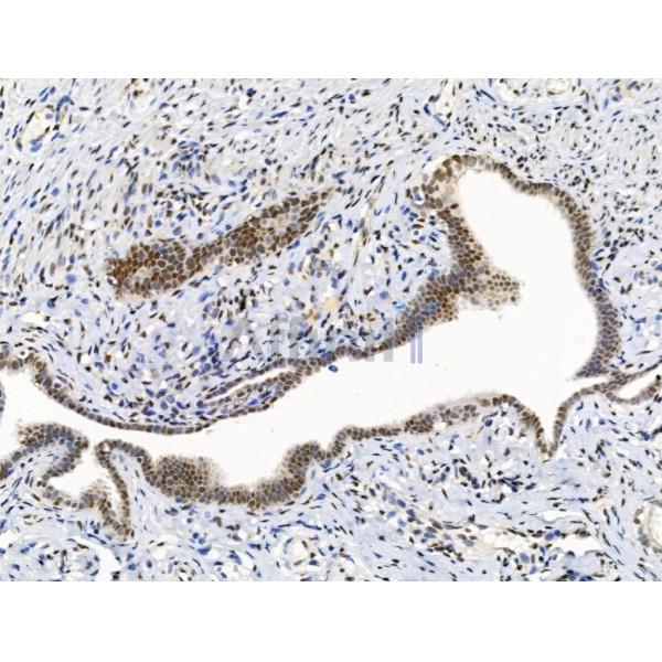 KMT2A / MLL Antibody - DF13551 at 1/100 staining Human kidney cancer by IHC-P.