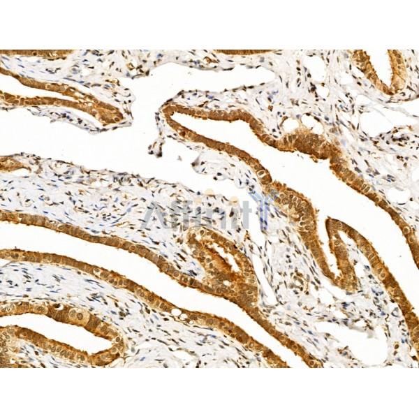 Nanos3 Antibody - DF13559 at 1/100 staining Human kidney cancer by IHC-P.
