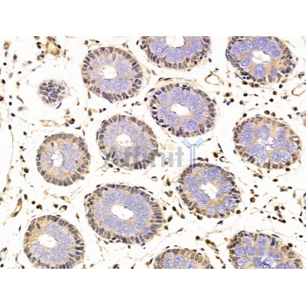 C9orf142 Antibody - DF13585 at 1/100 staining Human colorectal cancer and adjacent normal tissues by IHC-P.