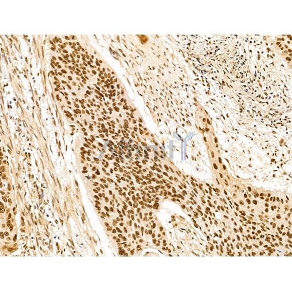 KLF2 Antibody - DF13602 at 1/100 staining Human esophageal cancer by IHC-P.