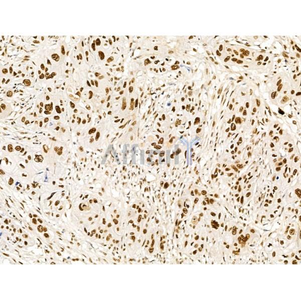 KLF2 Antibody - DF13602 at 1/100 staining Human esophageal cancer by IHC-P.