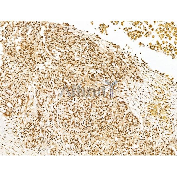 KLF2 Antibody - DF13602 at 1/100 staining Human ovarian cancer by IHC-P.