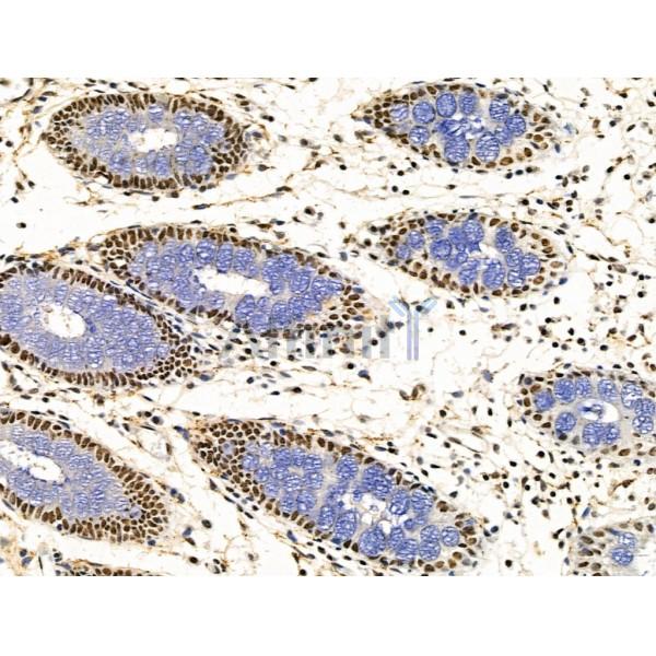 KLF2 Antibody - DF13602 at 1/100 staining Human colorectal cancer and adjacent normal tissues by IHC-P.