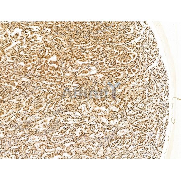 KLF2 Antibody - DF13602 at 1/100 staining Human kidney cancer by IHC-P.