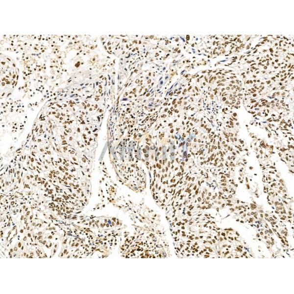 KLF2 Antibody - DF13602 at 1/100 staining Human pancreatic cancer by IHC-P.