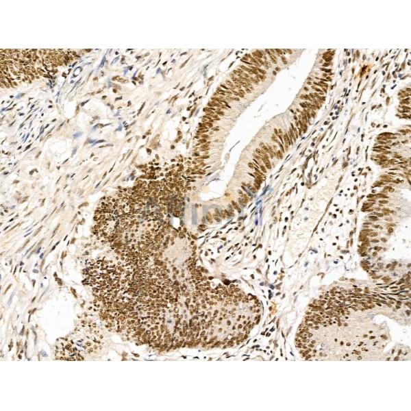 KLF2 Antibody - DF13602 at 1/100 staining Human colorectal cancer by IHC-P.