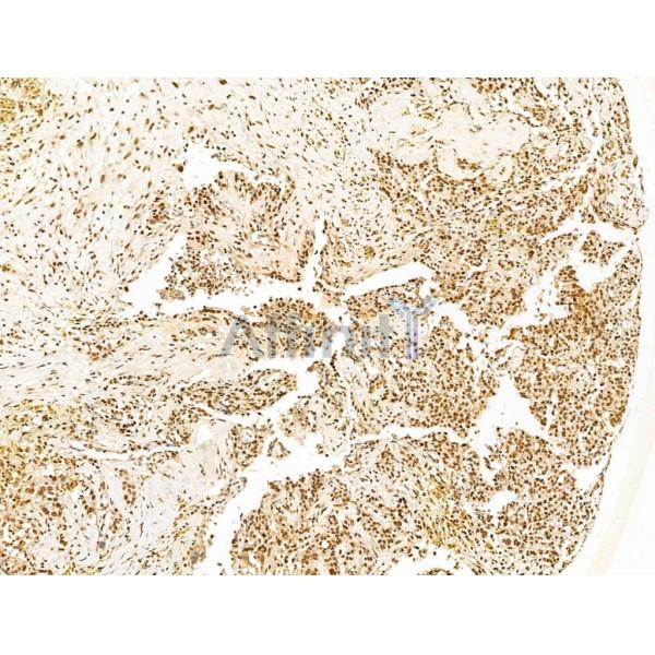KLF2 Antibody - DF13602 at 1/100 staining Human ovarian cancer by IHC-P.