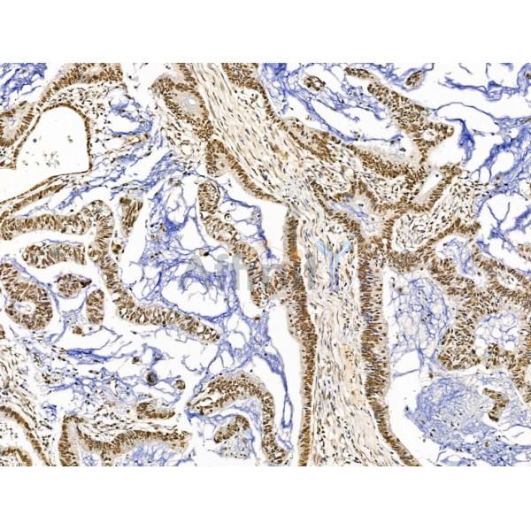 KLF2 Antibody - DF13602 at 1/100 staining Human colorectal cancer by IHC-P.