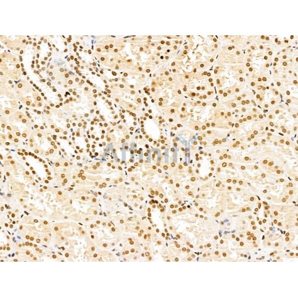 KLF2 Antibody - DF13602 at 1/100 staining Human kidney cancer and adjacent normal tissues by IHC-P.