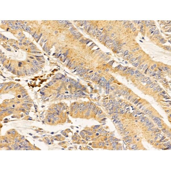 PRMT3 Antibody - DF13606 at 1/100 staining Human colorectal cancer and adjacent normal tissues by IHC-P.