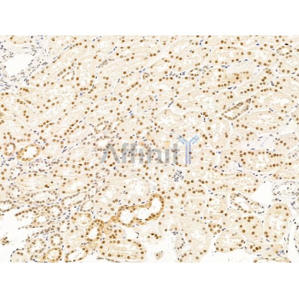 Nesprin 1 Antibody - DF13608 at 1/100 staining Human kidney cancer and adjacent normal tissues by IHC-P.
