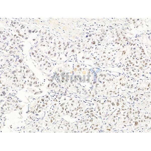 Nesprin 1 Antibody - DF13608 at 1/100 staining Human pancreatic cancer by IHC-P.