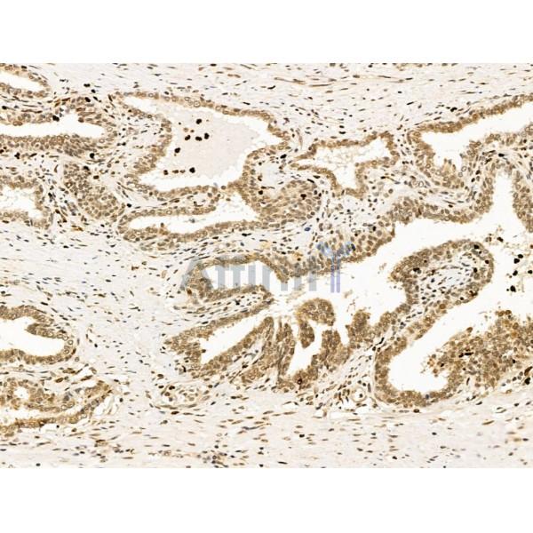 Nesprin 1 Antibody - DF13608 at 1/100 staining Human colorectal cancer by IHC-P.