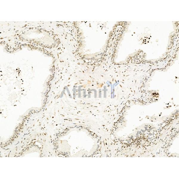 Nesprin 1 Antibody - DF13608 at 1/100 staining Human ovarian cancer by IHC-P.