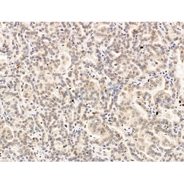 Nesprin 1 Antibody - DF13608 at 1/100 staining Human kidney cancer by IHC-P.