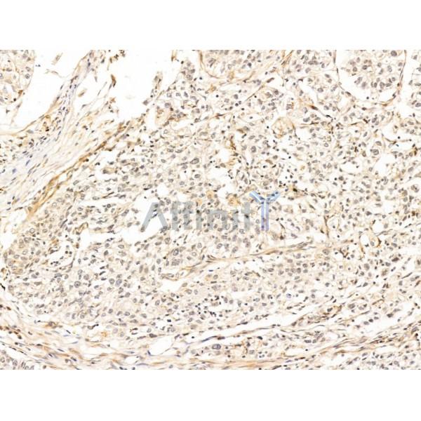 SSRP1 Antibody - DF13616 at 1/100 staining Human pancreatic cancer by IHC-P.