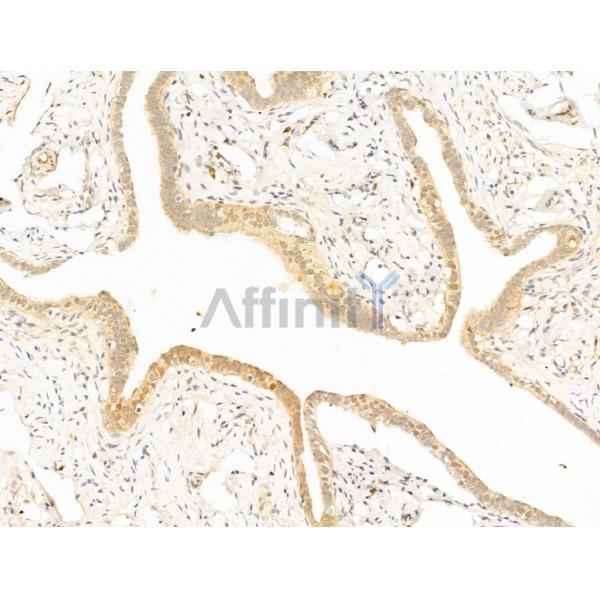 AIMP3/p18 Antibody - DF13629 at 1/100 staining Human ovarian cancer by IHC-P.