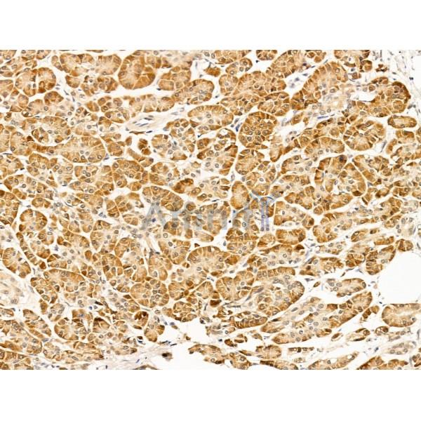 AIMP3/p18 Antibody - DF13629 at 1/100 staining Human pancreatic cancer and adjacent nomal tissues by IHC-P.