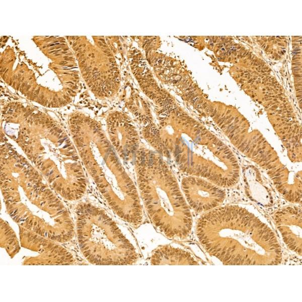 E1 Ubiquitin Activating Enzyme Antibody - DF13630 at 1/100 staining Human colorectal cancer by IHC-P.
