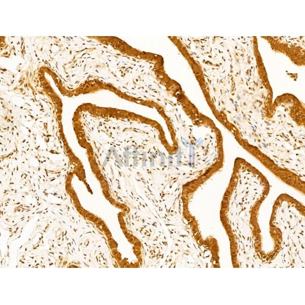 E1 Ubiquitin Activating Enzyme Antibody - DF13630 at 1/100 staining Human kidney cancer by IHC-P.