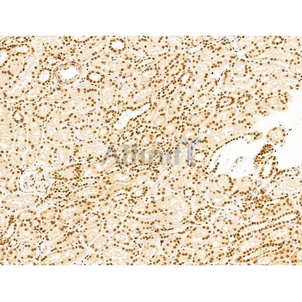 TIM 4 Antibody - DF13636 at 1/100 staining Human kidney cancer and adjacent normal tissues by IHC-P.