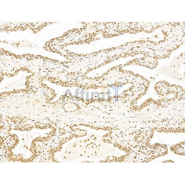 TIM 4 Antibody - DF13636 at 1/100 staining Human colorectal cancer by IHC-P.