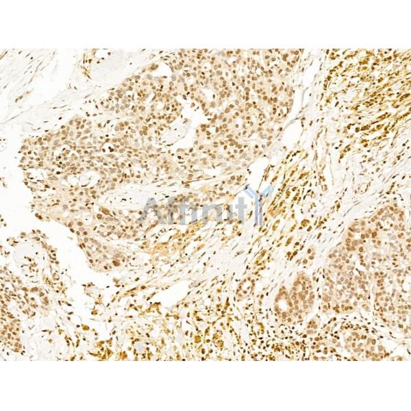TIM 4 Antibody - DF13636 at 1/100 staining Human ovarian cancer by IHC-P.