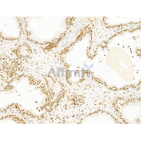 TIM 4 Antibody - DF13636 at 1/100 staining Human ovarian cancer by IHC-P.