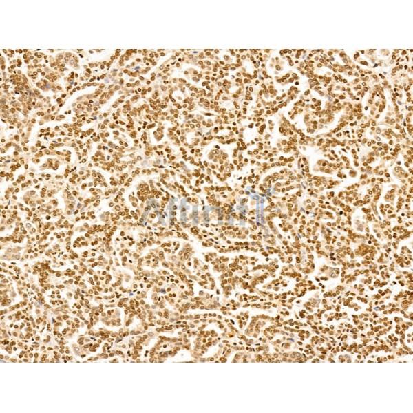 TIM 4 Antibody - DF13636 at 1/100 staining Human kidney cancer by IHC-P.