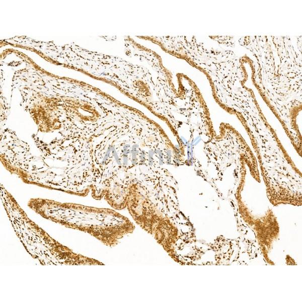 TIM 4 Antibody - DF13636 at 1/100 staining Human ovarian cancer and adjacent normal tissues by IHC-P.
