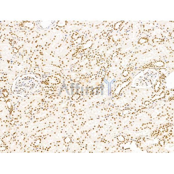 ILF1 Antibody - DF13638 at 1/100 staining Human kidney cancer and adjacent normal tissues by IHC-P.