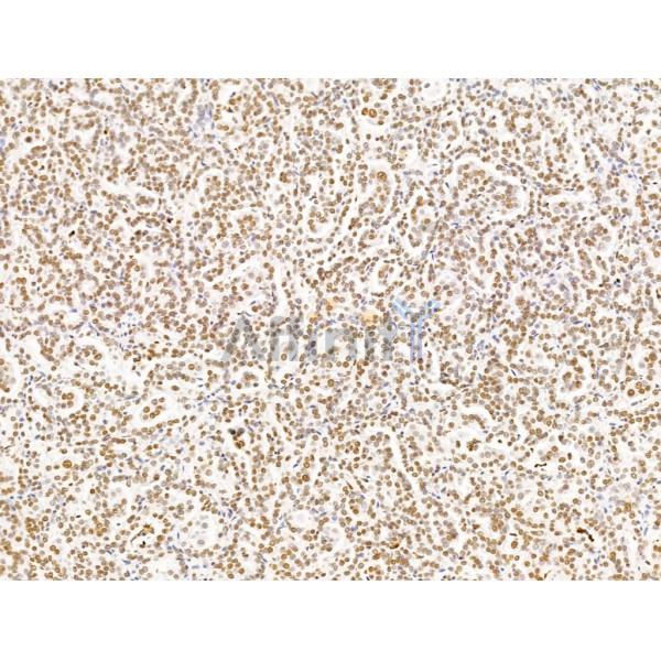 ILF1 Antibody - DF13638 at 1/100 staining Human kidney cancer by IHC-P.