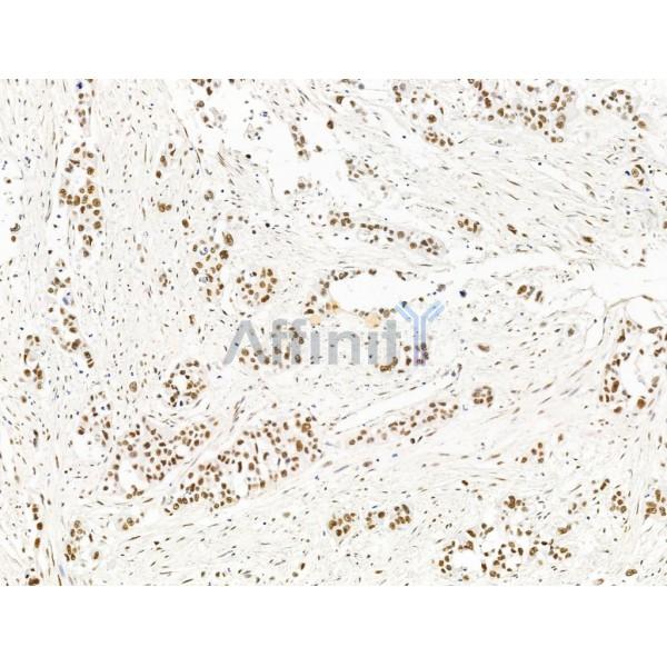 ILF1 Antibody - DF13638 at 1/100 staining Human gastric cancer by IHC-P.