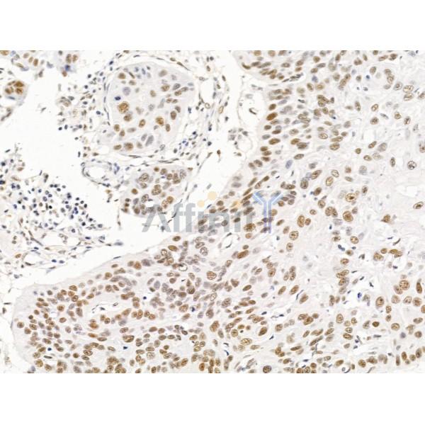 ILF1 Antibody - DF13638 at 1/100 staining Human esophageal cancer by IHC-P.