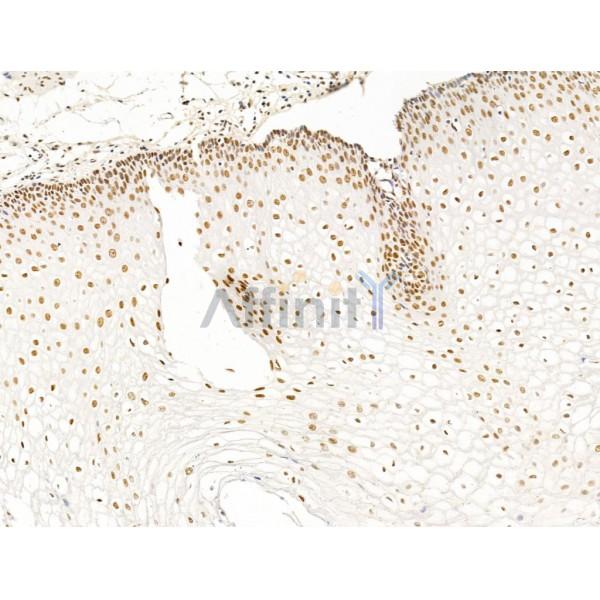 ILF1 Antibody - DF13638 at 1/100 staining Human esophageal cancer and adjacent normal tissues by IHC-P.