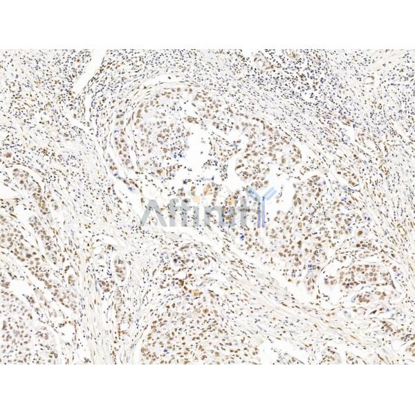 ILF1 Antibody - DF13638 at 1/100 staining Human pancreatic cancer by IHC-P.