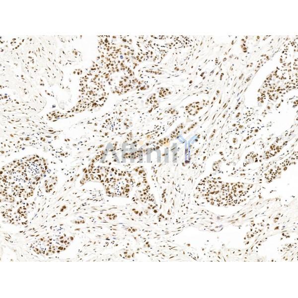 ILF1 Antibody - DF13638 at 1/100 staining Human gastric cancer by IHC-P.