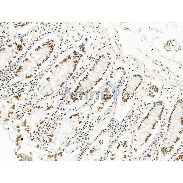 ILF1 Antibody - DF13638 at 1/100 staining Human gastric cancer and adjacent normal tissues by IHC-P.