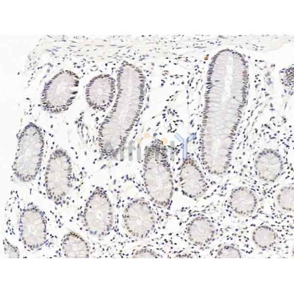 ILF1 Antibody - DF13638 at 1/100 staining Human colorectal cancer and adjacent normal tissues by IHC-P.