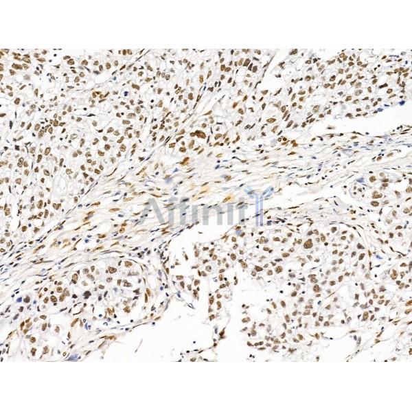 ILF1 Antibody - DF13638 at 1/100 staining Human pancreatic cancer by IHC-P.