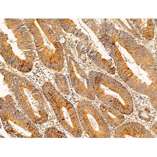 Filaggrin Antibody - DF13653 at 1/100 staining Human colorectal cancer and adjacent normal tissues by IHC-P.