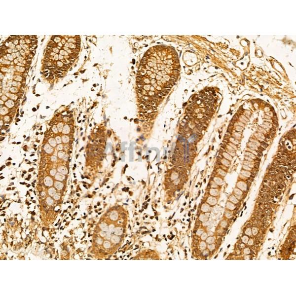 Filaggrin Antibody - DF13653 at 1/100 staining Human esophageal cancer by IHC-P.