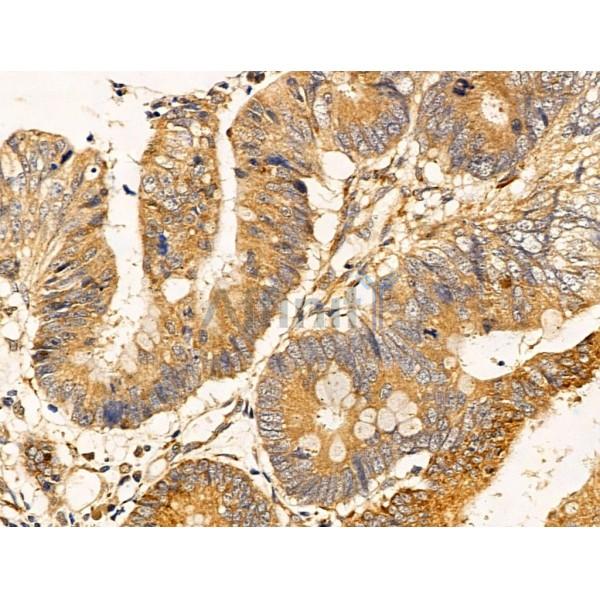Filaggrin Antibody - DF13653 at 1/100 staining Human colorectal cancer by IHC-P.