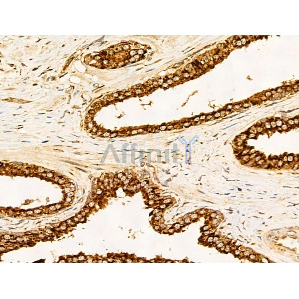 Filaggrin Antibody - DF13653 at 1/100 staining Human colorectal cancer by IHC-P.