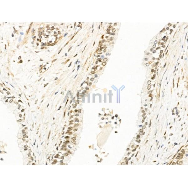 RECQL5 Antibody - DF13664 at 1/100 staining Human ovarian cancer by IHC-P.
