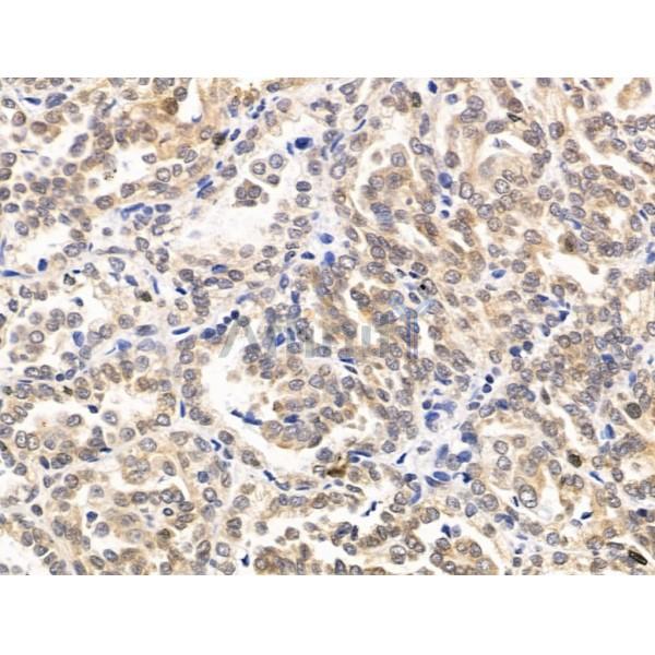 RECQL5 Antibody - DF13664 at 1/100 staining Human kidney cancer by IHC-P.